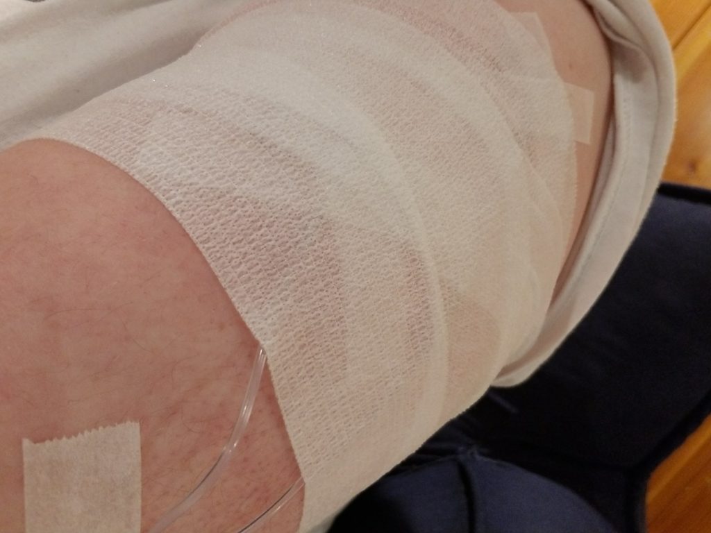 My arm wrapped during my first immunoglobulin infusion